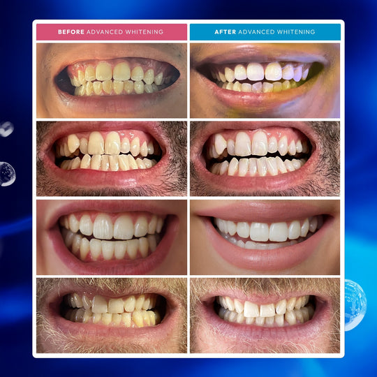 Before and after using the teeth whitener