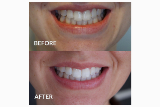 Teeth whitening review - direct from a beauty expert