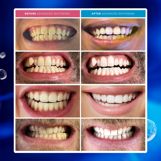 Teeth Whitening Kit (Couples Bundle)