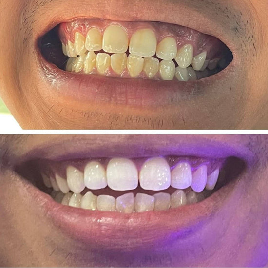 whitening kit before and after