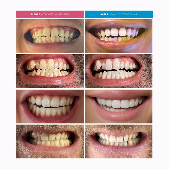 Advanced Teeth Whitening Kit